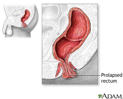 J-Run reccomend Prolapsing through anus