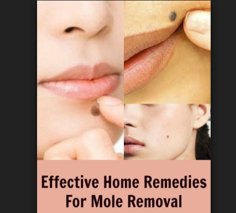 Home remedies on facial mole removal