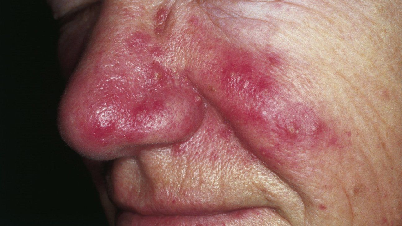 Circular red facial rash