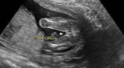 Black L. reccomend Incorrect sex diagnosis from ultrasound