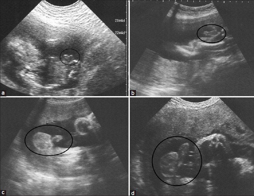 Big B. reccomend Incorrect sex diagnosis from ultrasound