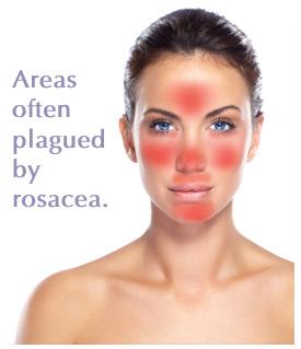 Lava reccomend Blue lizard facial sunscreen spf rosacea