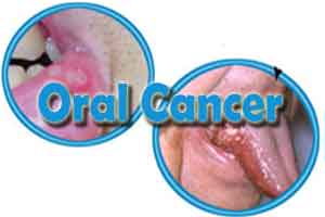 Hpv transmission risk oral sex